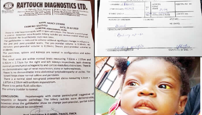 Edo Mother Appeals for Assistance for Daughter Battling Liver Disease